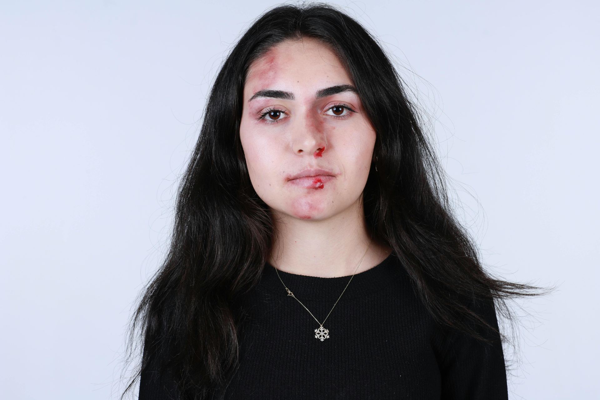 Injured woman with facial bruising